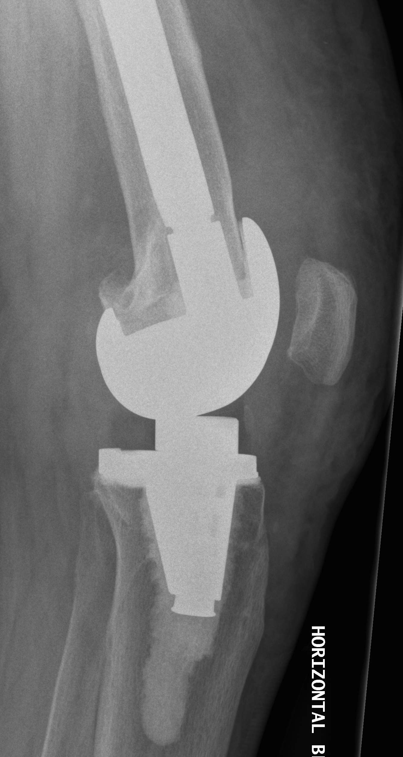 Revision TKR Quadriceps Rupture Lars Ligament Repair